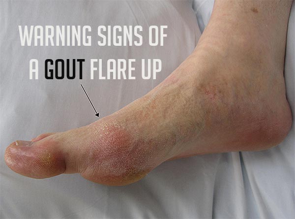 warning signs of a gout flare up