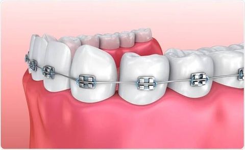 Understanding Dental Clips and Their Role in Teeth Alignment