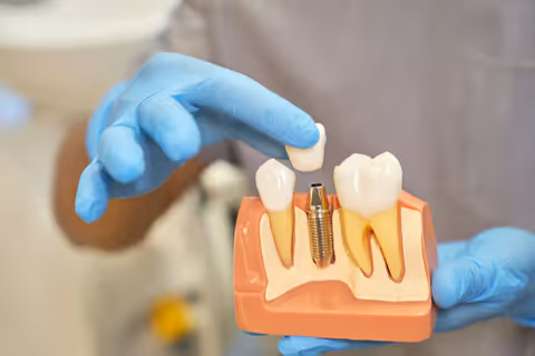 Dental Implants: A Complete Guide to Tooth Replacement