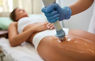 Minimally Invasive Cellulite Treatment - What to Expect Before and After