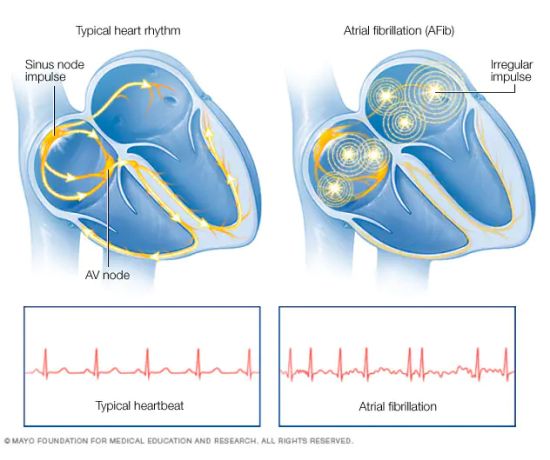 5 Drinks to Avoid If You Have Atrial Fibrillation (AFib)