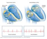 5 Drinks to Avoid If You Have Atrial Fibrillation (AFib)